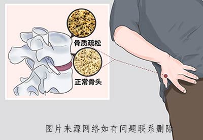 骨密度检测仪器厂家品牌介绍：其实骨密度没必要检测你能做到以下几点远离骨质疏松