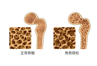 骨密度仪品牌：“何不食肉糜”张专家再谈四小时睡眠，保障睡眠增加骨密度