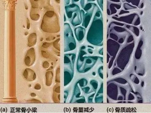 河北承德GK-7000骨密度检测仪厂家：骨质疏松要少吃哪些食物