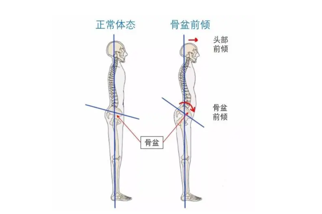 7.5国康资讯：超声骨密度分析仪厂家介绍什么事骨盆前倾，发生的原因是什么?