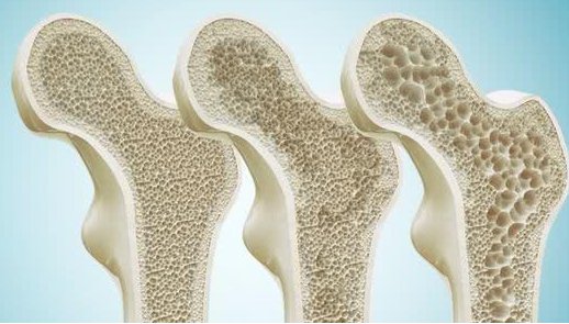 超声骨密度测试仪生产厂家:骨量or骨质疏松?这两个是一样的吗?各有什么不同,快来看下